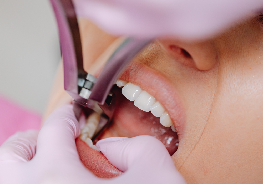 patient undergoing tooth extractions in California, MD